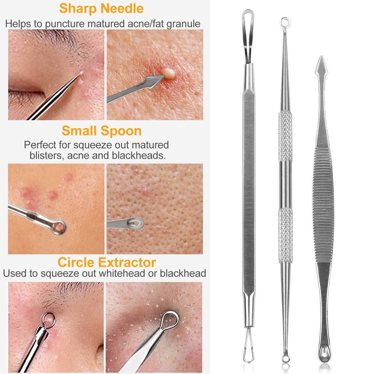 5-Piece Set: Blackhead Remover Kit Stainless Steel Popping Zit Remover DailySale