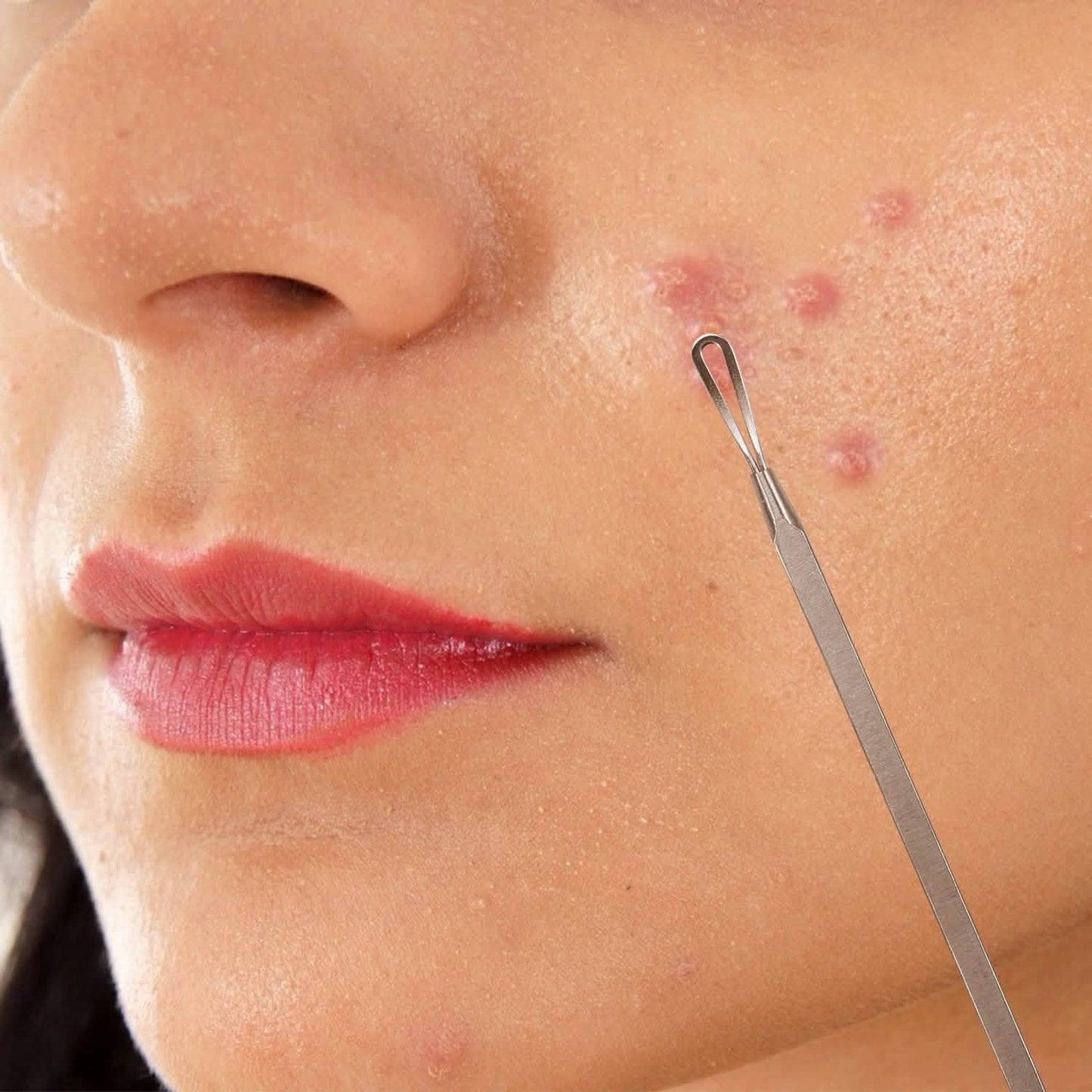 7-Pieces: Blackhead Remover Stainless Steel DailySale