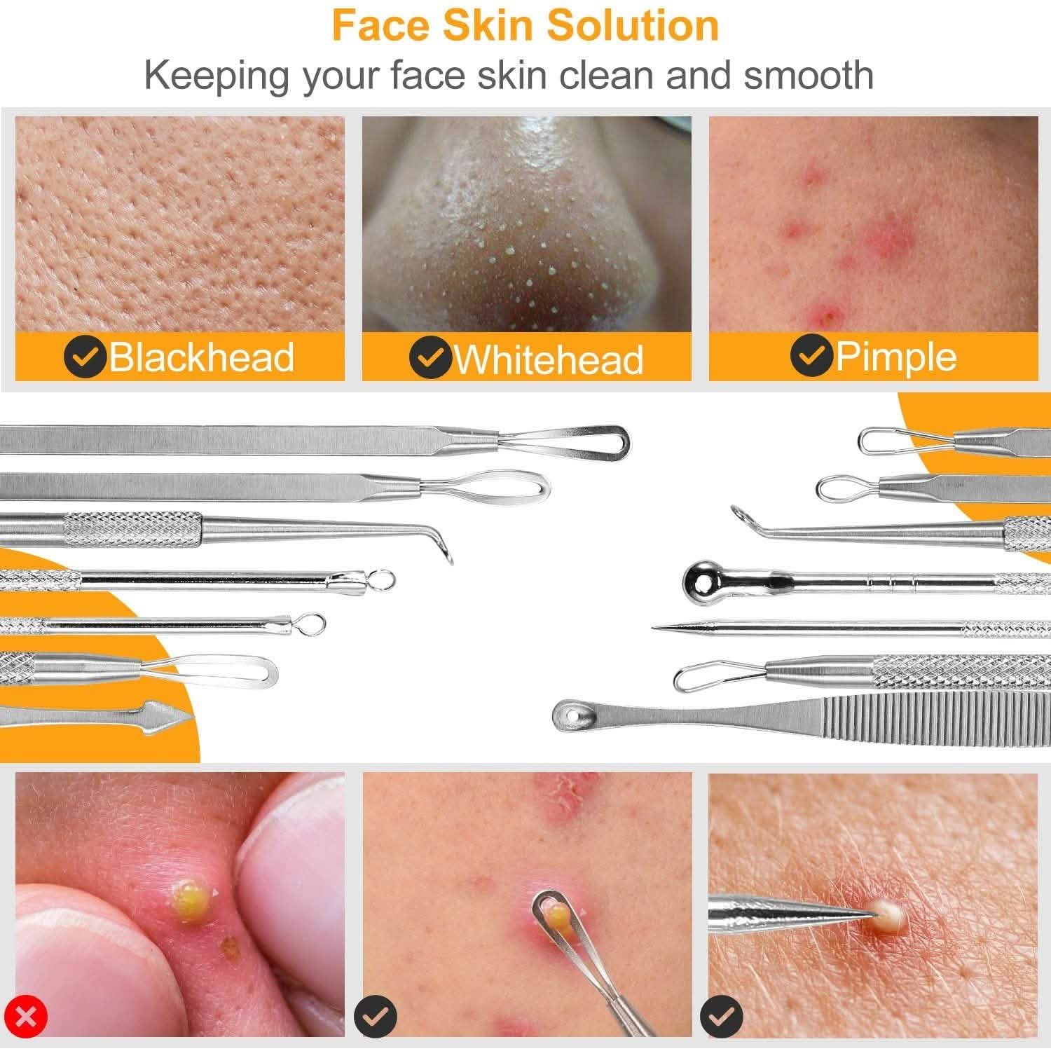 7-Pieces: Blackhead Remover Stainless Steel DailySale
