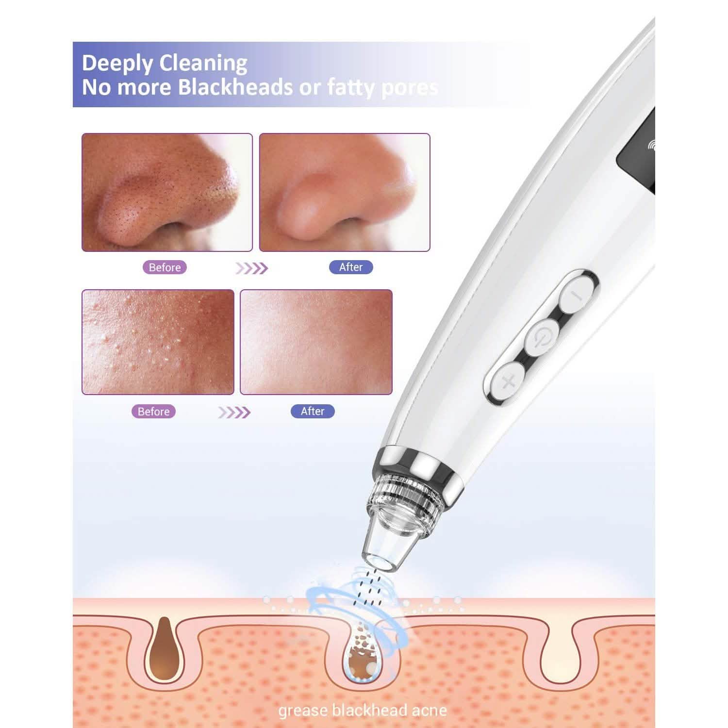 Blackhead Pore Vacuum Cleaner Remover DailySale