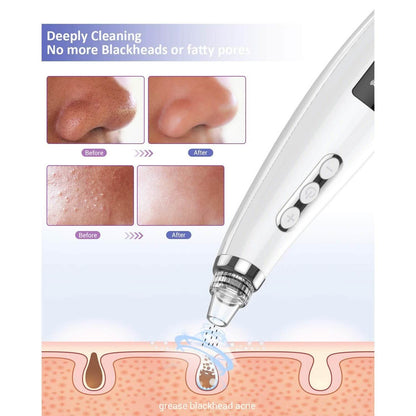 Blackhead Pore Vacuum Cleaner Remover DailySale