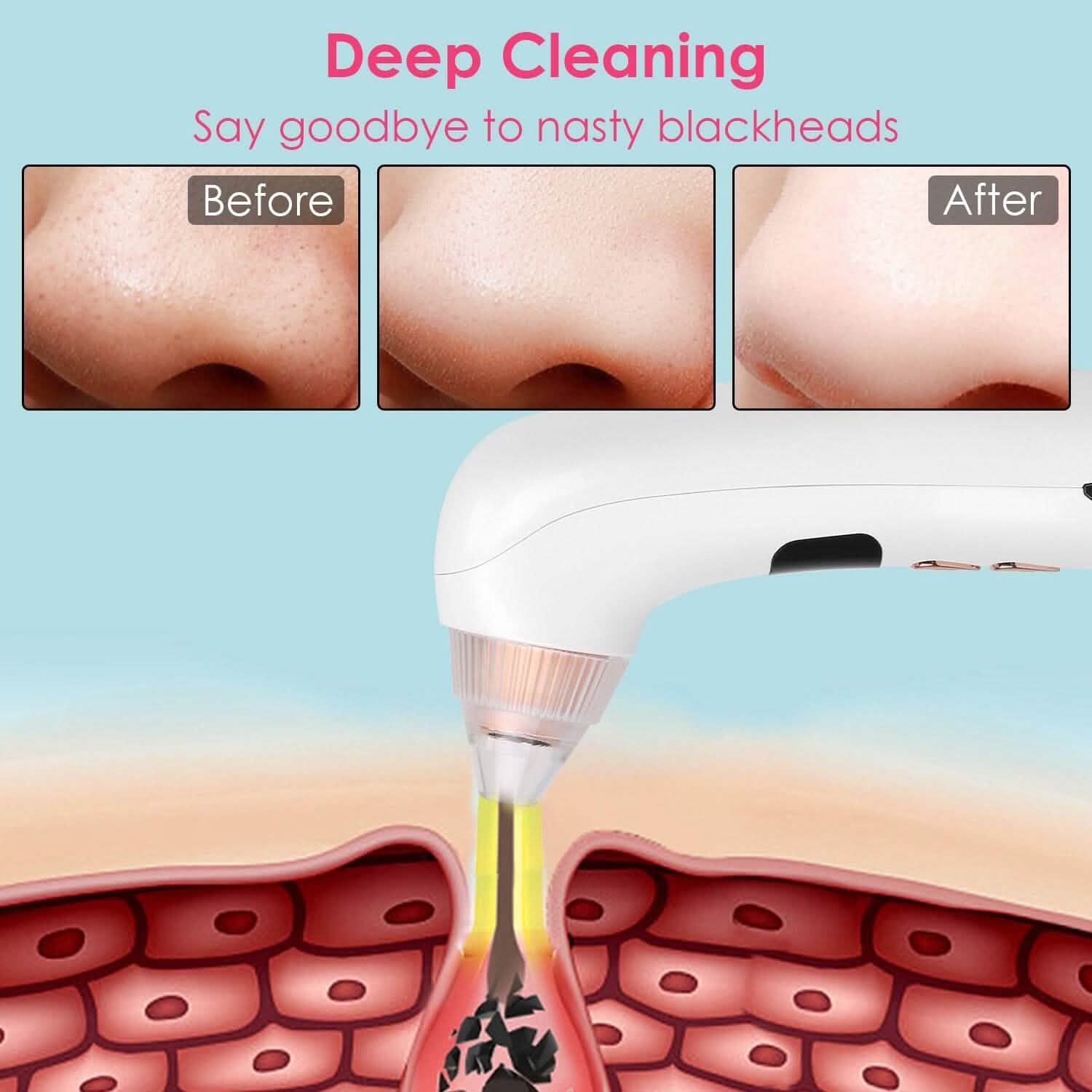 Blackhead Vacuum Remover Electric Blackhead Comedone Extractor DailySale