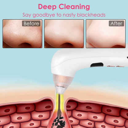 Blackhead Vacuum Remover Electric Blackhead Comedone Extractor DailySale