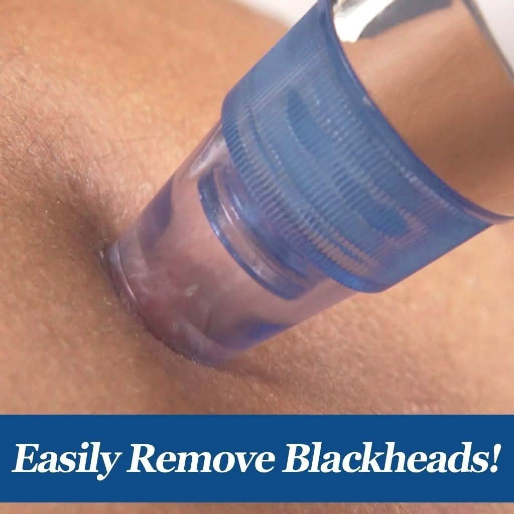 DermaSuction Blackhead Remover DailySale
