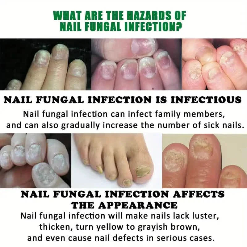 Ginger Nail Care Liquid Onychomycosis Fungus Repair Hand and Foot Nail Care DailySale