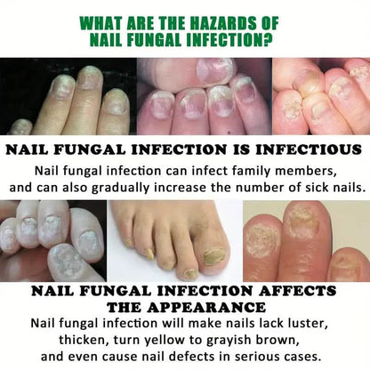Ginger Nail Care Liquid Onychomycosis Fungus Repair Hand and Foot Nail Care DailySale
