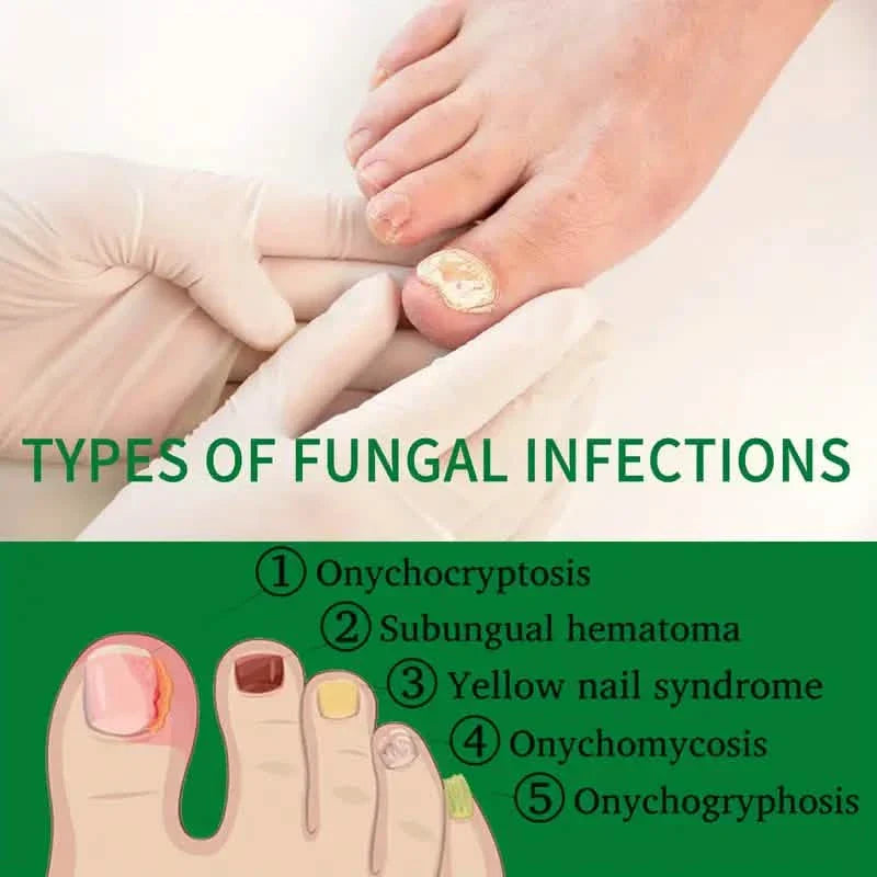 Ginger Nail Care Liquid Onychomycosis Fungus Repair Hand and Foot Nail Care DailySale