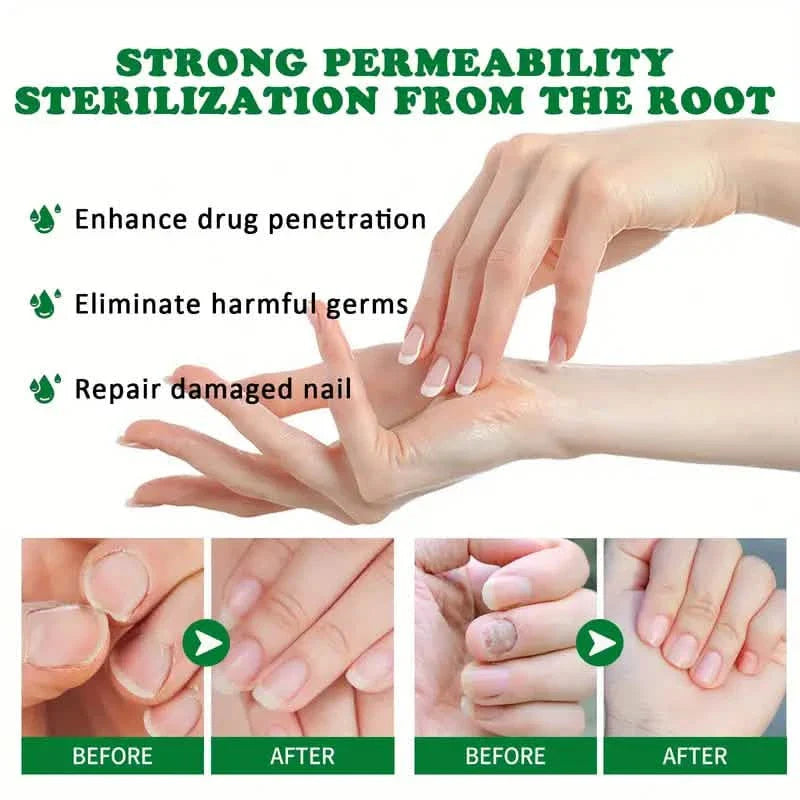 Ginger Nail Care Liquid Onychomycosis Fungus Repair Hand and Foot Nail Care DailySale