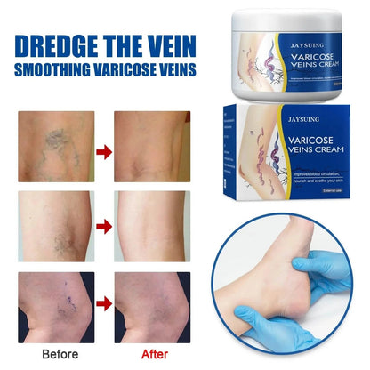 Pain Relief Leg Spider Veins Vasculitis Promote Circulation Smooth Metabolism 30g Exfoliation DailySale
