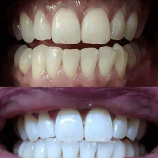 TrueWhite Advanced Plus 2 Person Whitening System DailySale