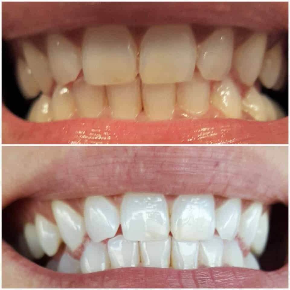 TrueWhite Advanced Plus 2 Person Whitening System DailySale